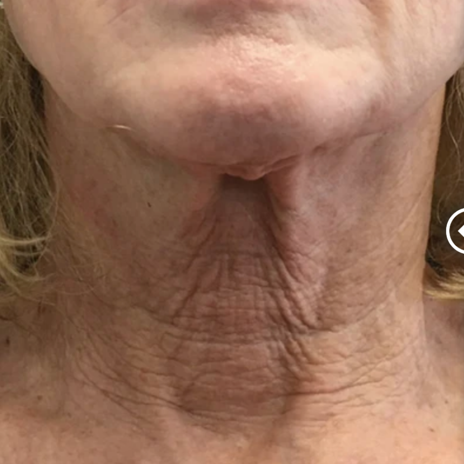 Restorative Neck Complex with TriHex Technology®