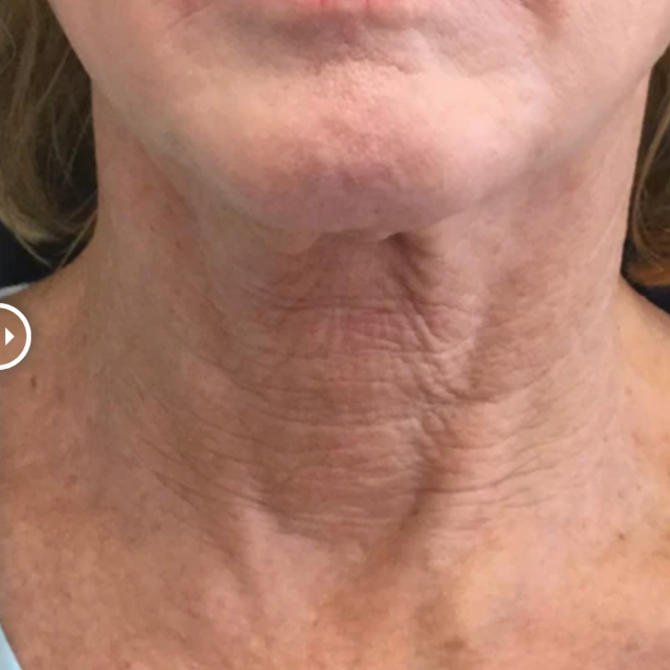 Restorative Neck Complex with TriHex Technology®