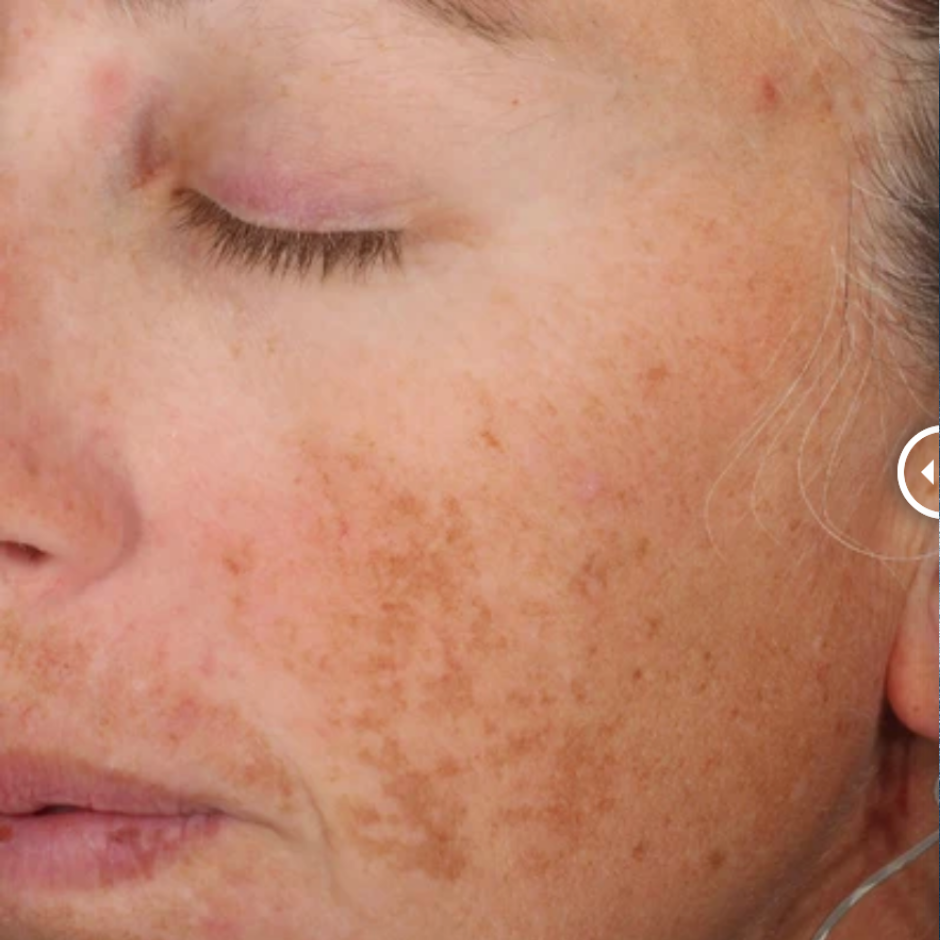 A-LUMINATE Brightening Serum™