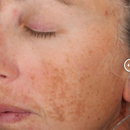 A-LUMINATE Brightening Serum™