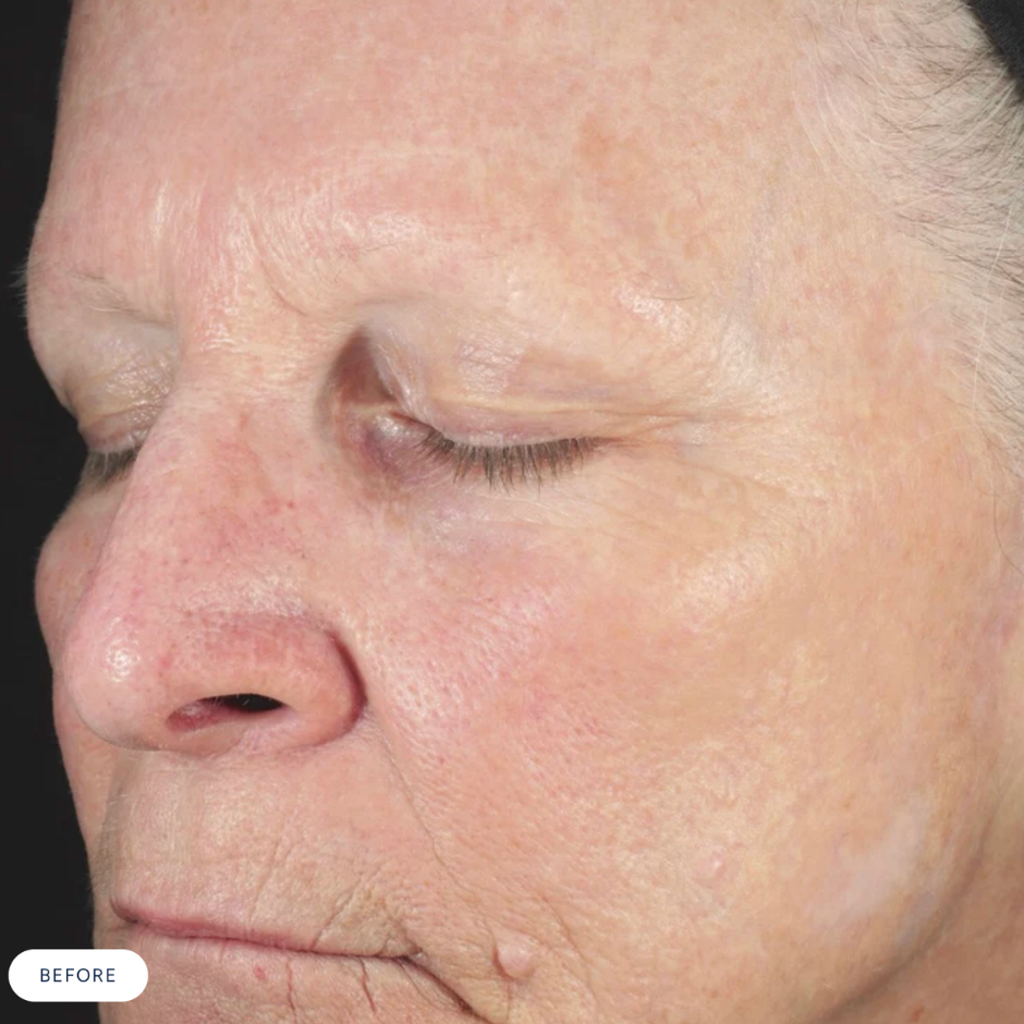 Renewing HA Serum