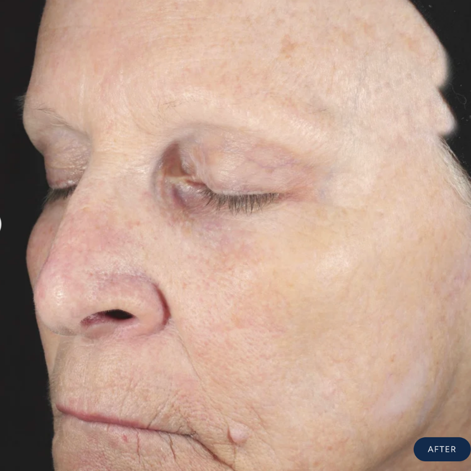 Renewing HA Serum